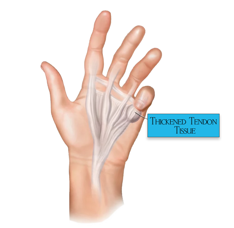Dupuytrens-contracture-disease