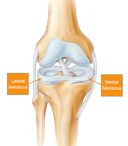 What Is A Torn Meniscus Meniscus Tear Total Ortho Center