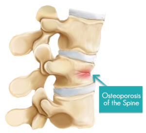 Osteoporosis-of-the-spine