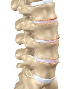 spinal-osteoarthritis