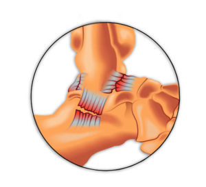 sprained-ankle-ligament