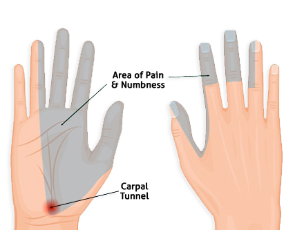 Carpal Tunnel Syndrome | Symptoms & Treatment | Total Ortho Center