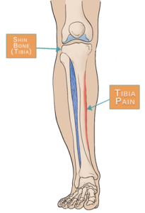 Shin Splints - Total Ortho Center
